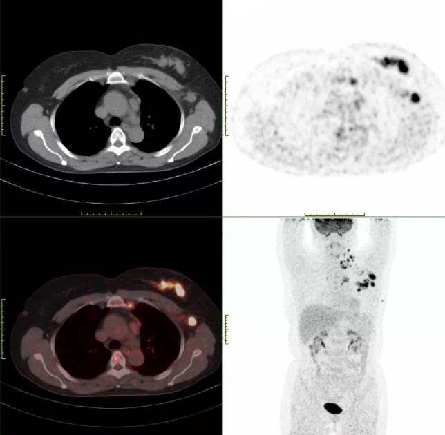 PET-CT：腫瘤檢查“核”武器(qì)