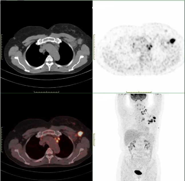 PET-CT：腫瘤檢查“核”武器(qì)