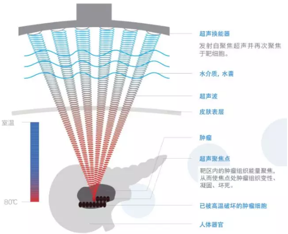 走進實體(tǐ)腫塊（包括實體(tǐ)腫瘤）綠色無創治療新時(shí)代——“海扶刀”正式落戶如臯廣慈醫(yī)院